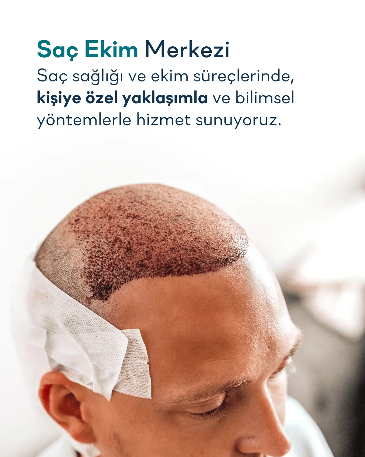 Saç Ekim Merkezi | Özel Dünyam Hastanesi